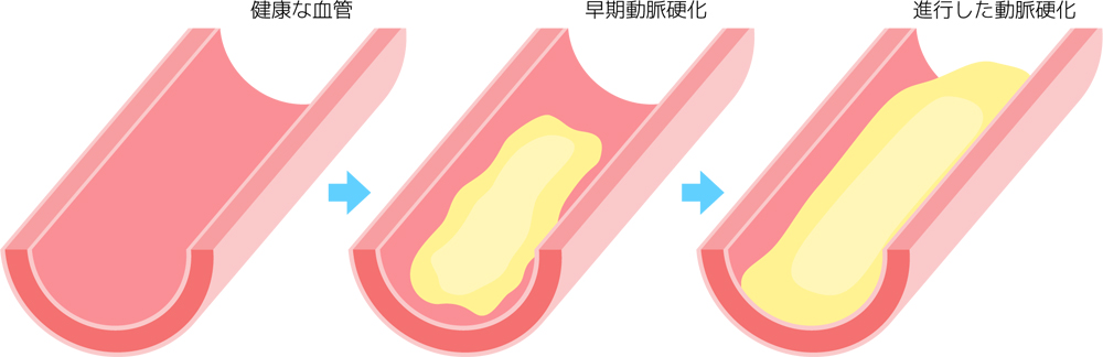 健康な血管と動脈硬化の進行