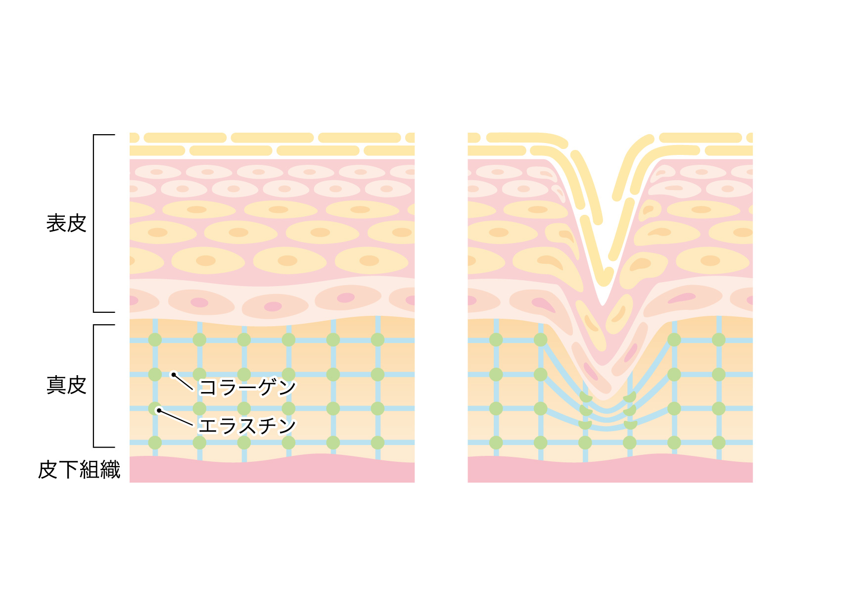 肌の断面図　コラーゲン低下による皺